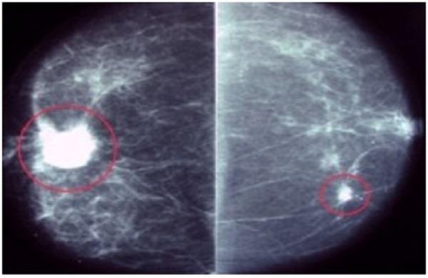 khi-nao-nen-tam-soat-ung-thu-vu